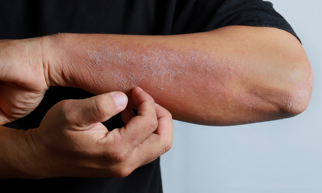 A close-up of bad psoriasis on a person's arm
