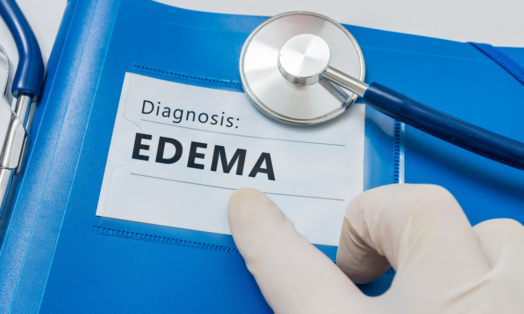 blue folder with diagnosis, edema written on it. and a stethoscope and hand pointing to edema