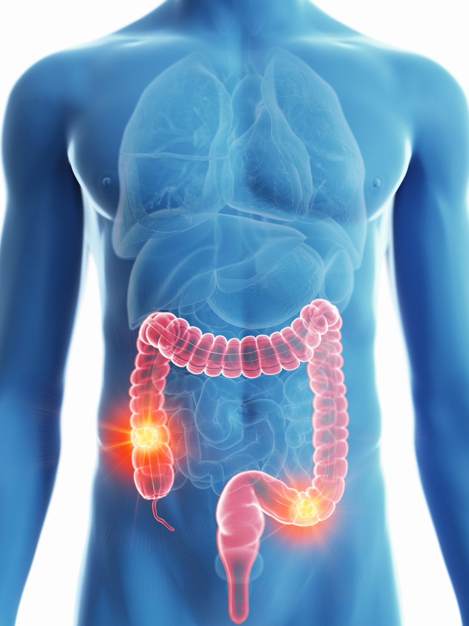 50-of-all-colon-cancer-cases-could-be-prevented-if-everybody-did-these