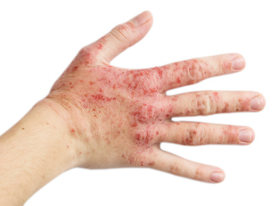 Eczema on a female right hand